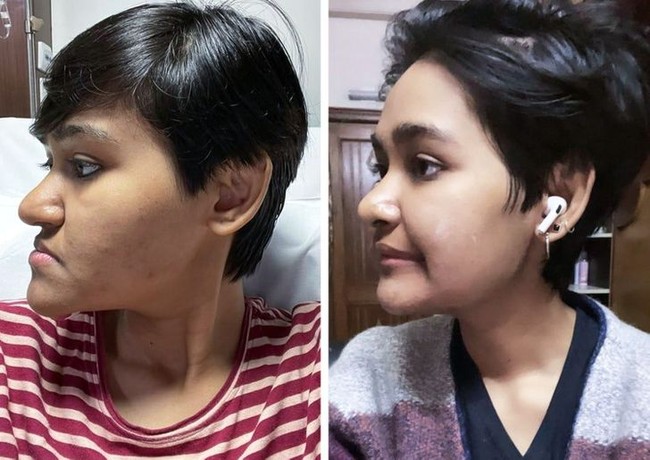 Terkadang operasi plastik tidak sekadar untuk urusan estetika, tapi untuk mendapatkan bentuk wajah lebih proporsional. Seperti wanita ini yang menunjukkan perubahan wajahnya 3 minggu setelah operasi plastik. Foto: AnkitaSehgal03 / reddit