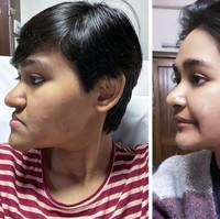 Terkadang operasi plastik tidak sekadar untuk urusan estetika, tapi untuk mendapatkan bentuk wajah lebih proporsional. Seperti wanita ini yang menunjukkan perubahan wajahnya 3 minggu setelah operasi plastik. Foto: AnkitaSehgal03 / reddit