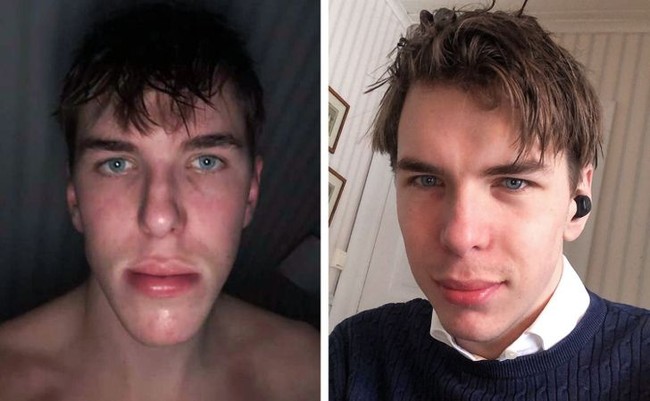 Wajah pria satu ini berubah sekitar 3 bulan pascaoperasi dagu. Foto: g**zalo_ / reddit