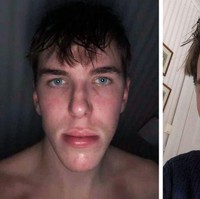 Wajah pria satu ini berubah sekitar 3 bulan pascaoperasi dagu. Foto: g**zalo_ / reddit