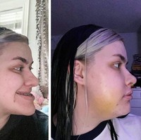 Ini penampakan profil samping wajahnya, sebelum dan setelah 6 hari operasi plastik. Tampak wajahnya terlihat jauh lebih proporsional. Foto: nir***inh*** / reddit