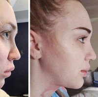 Wanita ini langsung mengunggah perubahan pada hidung dan dagunya, beberapa saat setelah prosedur kecantikan. Foto: sillystring1881 / reddit