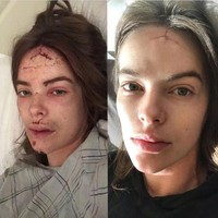 Hal tersebut memecahakn tengkorak, dan membelah dagu bibir dan dahinya. Insiden tersebut meninggalkan bekas luka yang cukup terlihat di dahinya.  Foto: Dok. Instagram/@robynlawley