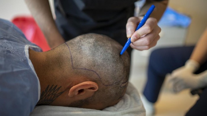Cangkok Rambut/Transplantasi Rambut Hair Transplant