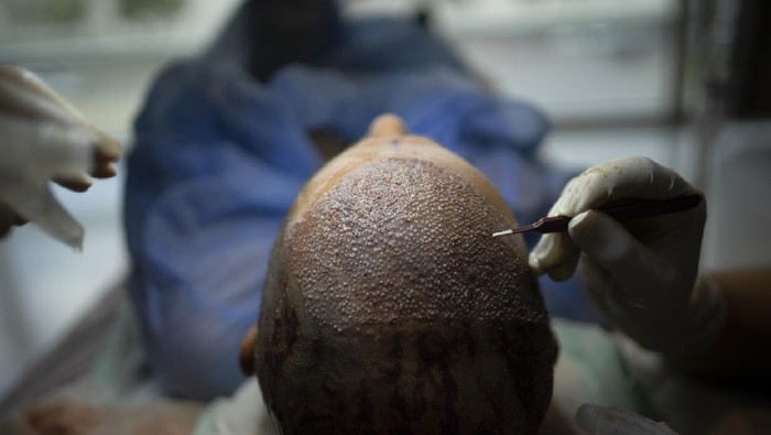 Hair Transplant