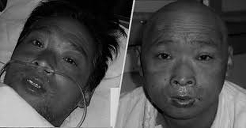 Hisashi Ouchi tidak pernah menyangka kehidupan indahnya terenggut dan berakhir dengan siksaan rasa sakit di 83 hari terakhir masa hidupnya. Semua karena paparan radiasi besar yang dialami dirinya.

Kembali pada 30 September 1999, Hisashi Ouchi terkena kejadian buruk di Pembangkit Listrik Tenaga Nuklir (PLTN) Tokaimura yang membuat organ internalnya hancur dan kulitnya mengelupas.  Hisashi Ouchi tidak sendiri, ia bekerja saat itu dengan dua rekannya untuk mengisi tangki pengendapan. Ialah Masato Shinohara dan Yutaka Yokokawa.

Hisashi Ouchi merupakan salah satu teknisi yang bekerja di sebuah fasilitas yang dioperasikan oleh JCO (formerly Japanese Nuclear Fuel Conversion Co) di Tokai, Ibaraki Perfecture.