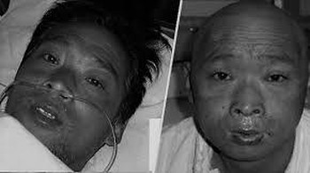 Hisashi Ouchi: Penyakit karena radiasi sangat menyakitkan. Salah satu kematian terburuk terkait nuklir adalah di desa Tokai, Jepang. Di 1999, teknisi Hisashi Ouchi yang bekerja di PLTN Tokaimura bertugas memurnikan uranium oksida di pabrik pengolahan bahan bakar nuklir. Dia dan rekannya tak sengaja memicu pelepasan radiasi dari reaksi berantai nuklir tak terkendali. Ouchi langsung mual dan disorientasi. Di rumah sakit, diketahui insiden itu menghancurkan sistem kekebalan tubuh. Hanya masalah waktu sebelum dia meninggal. Keluarganya bersikeras agar dokter melakukan segala cara, membiarkan Ouchi hidup berbulan-bulan. Ouchi akhirnya meninggal karena serangan jantung hebat.Foto: Komunitas Muda Nuklir Nasional