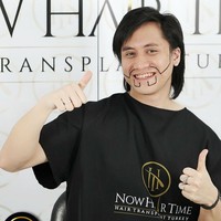 Demi mendapatkan tampilan rambut yang lebih tebal, Kevin Aprilio melakukan cangkok rambut di Turki. Inilah penampilan Kevin saat menjalani transplantasi rambut. Foto: Dok. Instagram/@now.hairtime