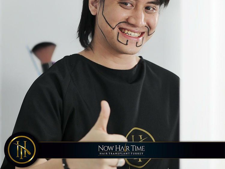 7 Foto Kevin Aprilio Cangkok Rambut di Turki, Sempat Tampil Botak