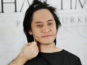 Mengenal Cangkok Rambut Seperti yang Dilakukan Kevin Aprilio