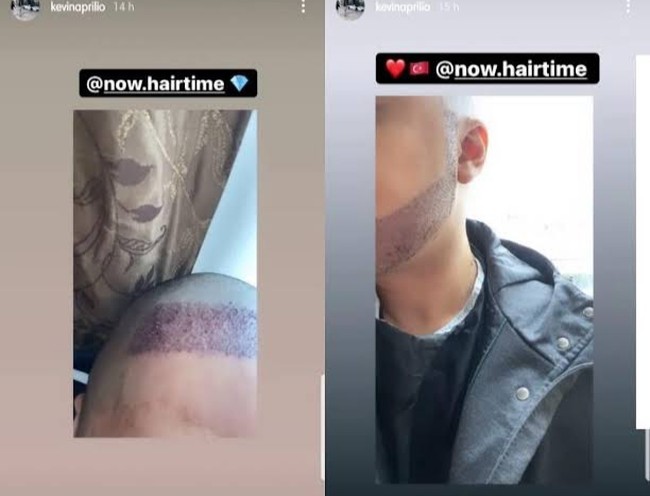 Di Instagram Storynya, Kevin Aprilio terus meng-update kondisinya pasca transplantasi rambut. 3 hari setelah operasi. Bismillah menuju gondrong lagi, ungkapnya.  Foto: Dok. Instagram/@kevinaprilio