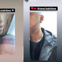 Di Instagram Storynya, Kevin Aprilio terus meng-update kondisinya pasca transplantasi rambut. 3 hari setelah operasi. Bismillah menuju gondrong lagi, ungkapnya.  Foto: Dok. Instagram/@kevinaprilio