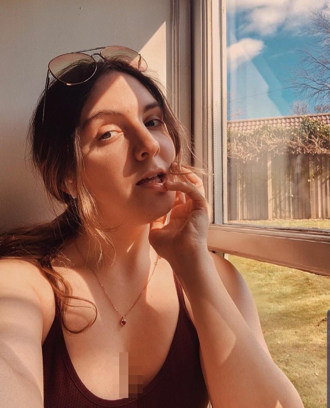 Becca mendapatkan operasi payudara gratis dari NHS, namun ia menolaknya. Tapi, Becca menolak implan payudara yang ditawarkannya. Foto: Dok. Instagram/@beccabutcherx