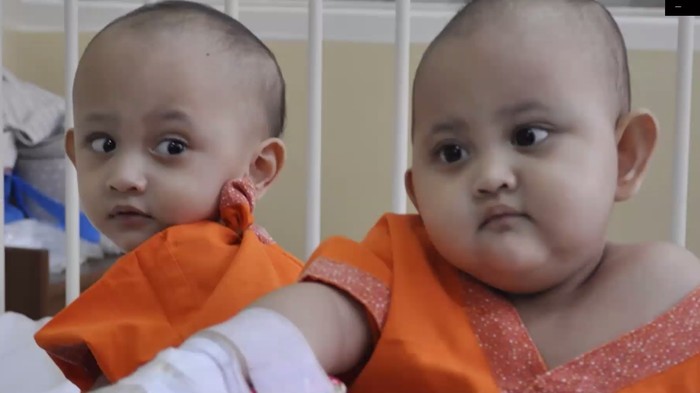 Bayi Kembar Siam Naifa-Nayyara Bayi Kembar Siam Naifa-Nayyara