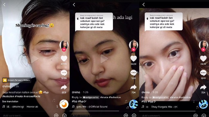 Viral TikTok Seorang wanita idap kista di mata, awalnya mengira bintitan.