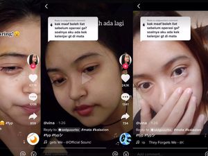 Viral Kista di Mata Disangka Bintitan, Tak Tahunya Kalazion dan Harus Operasi
