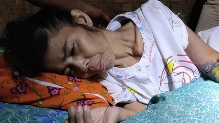 Ibu ini mengalami pembusukan kulit tangan kirinya.