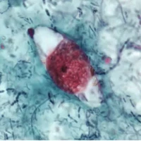Cystoispora Belli (Isospora Belli).