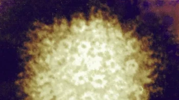Varicella zoster virus (VZV) adalah salah satu anggota keluarga virus herpes yang umumnya menyebabkan cacar air pada anak-anak. Foto: National Institute of Allergies and Infectious Diseases (NIAID)