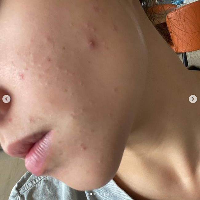 Akibat panik, Nikita Willy membersihkan wajahnya secara berlebihan, menggunakan facial wash dan scrub sesering mungkin. Foto: Instagram/nikitawillyofficial94