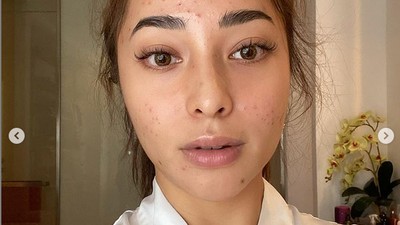 9 Foto Transformasi Wajah Nikita Willy dari Jerawatan Parah Kini Mulus