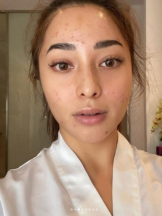 Bukannya membaik, jerawatnya malah tambah parah. Ia pun pergi ke klinik kecantikan dan berkonsultasi dengan dokter. Foto: Instagram/nikitawillyofficial94