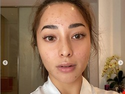 9 Foto Transformasi Wajah Nikita Willy dari Jerawatan Parah Kini Mulus