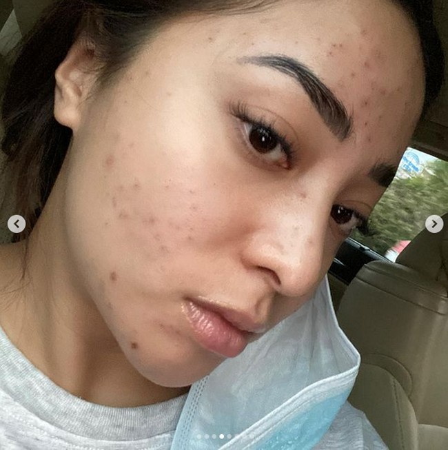Baru-baru ini Nikita Willy membagikan foto-foto dirinya ketika wajahnya sedang mengalami breakout. Nikita bahkan mengaku bahwasaat wajahnya dipenuhi jerawat itu dirinya sampai stress dan menangis setiap hari. Untungnya kini kulit wajahnya sudah kembali mulus seperti sedia kala. Foto: Instagram/nikitawillyofficial94