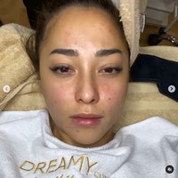 Menurut dokter, lapisan pelindung kulitnya sudah rusak karena over exfoliation, atau pengelupasan kulit yang berlebihan. Akhirnya wajah Nikita Willy harus disuntik untuk meredakan jerawat yang meradang. Foto: Instagram/nikitawillyofficial94