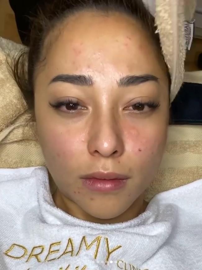 Menurut dokter, lapisan pelindung kulitnya sudah rusak karena over exfoliation, atau pengelupasan kulit yang berlebihan. Akhirnya wajah Nikita Willy harus disuntik untuk meredakan jerawat yang meradang. Foto: Instagram/nikitawillyofficial94