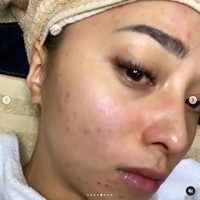 Perawatan kulit dilanjutkan dengan PRP, sebuah metode memasukkan serum ke dalam wajah yang terbuat dari plasma darah sendiri. Nikita Willy pun harus diet vegan terlebih dahulu agar produksi plasmanya lebih banyak dan berkualitas bagus. Foto: Instagram/nikitawillyofficial94