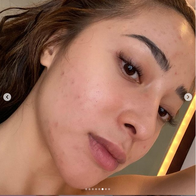 Dia juga menjalani ekstraksi komedo, serta diinfus kolagen untuk mempercepat penyembuhan. Sedangkan untuk perawatan di rumah Nikita Willy hanya menggunakan tiga produk yakni facial wash, serum dan pelembap. Foto: Instagram/nikitawillyofficial94