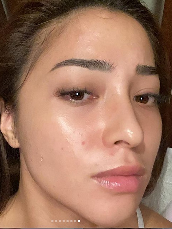 Awal 2021 jadi momen berat bagi Nikita Willy. Sepulangnya dari Raja Ampat, wajahnya ditumbuhi jerawat. Foto: Instagram/nikitawillyofficial94