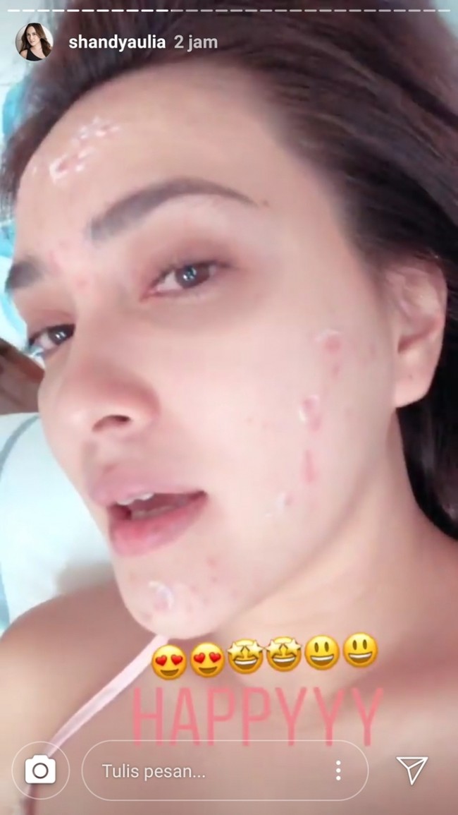 Kerap kali terlihat tampil dengan kulit mulus, ternyata Shandy Aulia juga pernah mengalami masalah jerawat pada kulit wajahnya. Walaupun demikian, Shandy dengan percaya diri mengunggah dan membagikan foto wajah berjerawatnya. Tetap cantik bukan? Foto: Instagram/@shandyaulia