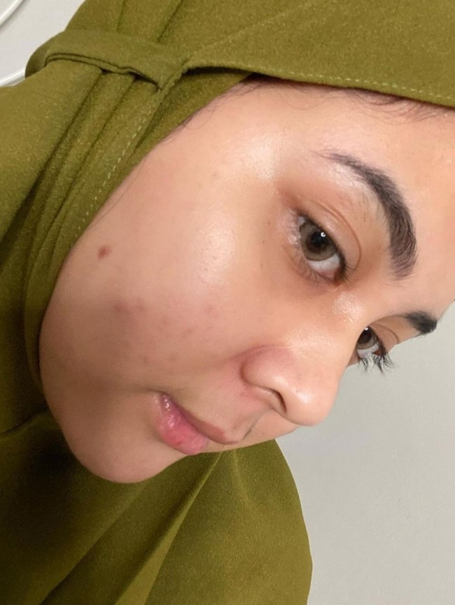 Walaupun mengaku sempat dibully karena wajahnya berjerawat namun Kesha Ratuliu dengan percaya diri memperlihatkan foto wajahnya ketika berjerawat. Padahal jerawat adalah hal yang wajar loh dan bisa disembuhkan. Foto: Instagram/@kesharatuliu05