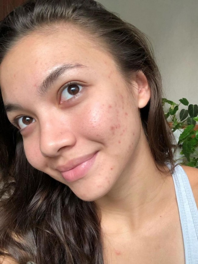 Angela Gilsha juga pernah membagikan foto kulit wajahnya ketika tengah berjerawat. Foto tersebut sengaja dibagikannya untuk menyerukan seruan self love, agar orang-orang bisa lebih mencintai diri sendiri apa adanya. Unggahannya itupun banjir pujian netizen. Foto: Instagram/@angelagilsha
