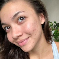 Angela Gilsha juga pernah membagikan foto kulit wajahnya ketika tengah berjerawat. Foto tersebut sengaja dibagikannya untuk menyerukan seruan self love, agar orang-orang bisa lebih mencintai diri sendiri apa adanya. Unggahannya itupun banjir pujian netizen. Foto: Instagram/@angelagilsha