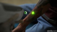 Relawan melakukan proses penghapusan tato di tangan warga. Proses penghapusan dilakukan dengan sejumlah tahapan.