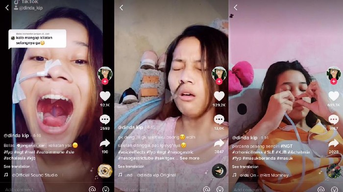 Idap Autoimun, Wanita Ini Bertahun-tahun Makan-minum Pakai Selang Lewat Hidung Idap Autoimun, Wanita Ini Bertahun-tahun Makan-minum Pakai Selang Lewat Hidung