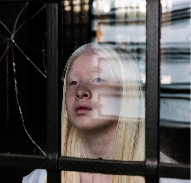 Karena kondisi albinonya, remaja 16 tahun itu tidak hanya kekurangan pigmen warna kulit, namun penglihatannya pun kurang jelas. Ia mengaku penglihatannya hanya 10%. Foto: dok. Instagram/@xueli_a