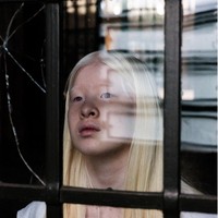 Karena kondisi albinonya, remaja 16 tahun itu tidak hanya kekurangan pigmen warna kulit, namun penglihatannya pun kurang jelas. Ia mengaku penglihatannya hanya 10%. Foto: dok. Instagram/@xueli_a