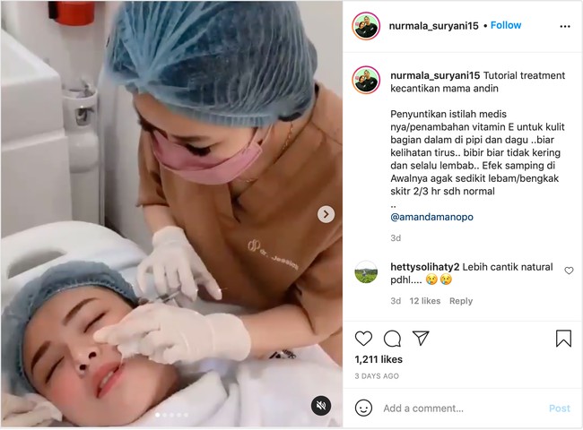 Ternyata penampilan Amanda Manopo itu terlihat berbeda bukan karena filler, melainkan suntik vitamin E. Dilansir dari Instagram @nurmala_suryani15, efek samping dari suntikan tersebut memang akan membuat sedikit lebam atau bengkak selama 3 hari. Foto: Instagram/@nurmala_suryani15
