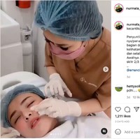 Ternyata penampilan Amanda Manopo itu terlihat berbeda bukan karena filler, melainkan suntik vitamin E. Dilansir dari Instagram @nurmala_suryani15, efek samping dari suntikan tersebut memang akan membuat sedikit lebam atau bengkak selama 3 hari. Foto: Instagram/@nurmala_suryani15