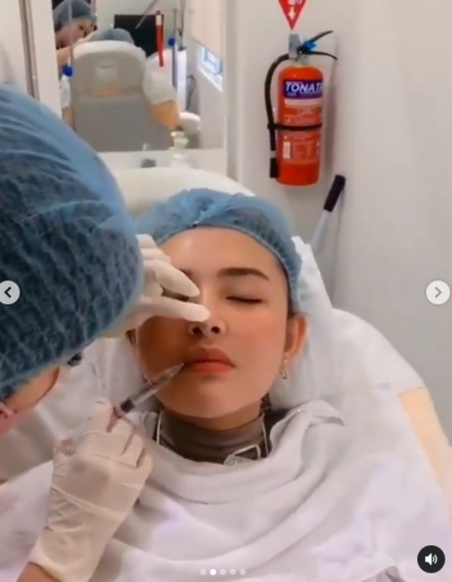 Treatment ini memiliki efek samping. Awalnya agak sedikit lebam/bengkak skitr 2/3 hr sdh normal, demikian tertulis di keterangan video tersebut. (Foto: Instagram/@nurmala_suryani15)