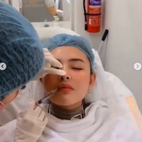 Treatment ini memiliki efek samping. Awalnya agak sedikit lebam/bengkak skitr 2/3 hr sdh normal, demikian tertulis di keterangan video tersebut. (Foto: Instagram/@nurmala_suryani15)