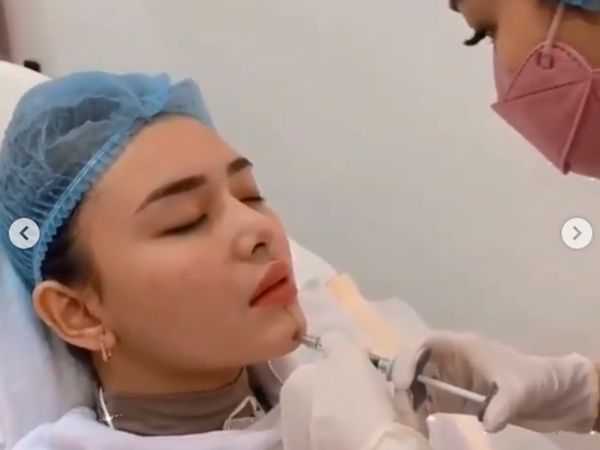 7 Momen Amanda Manopo Suntik Dagu dan Bibir, Bikin Wajah Lebam
