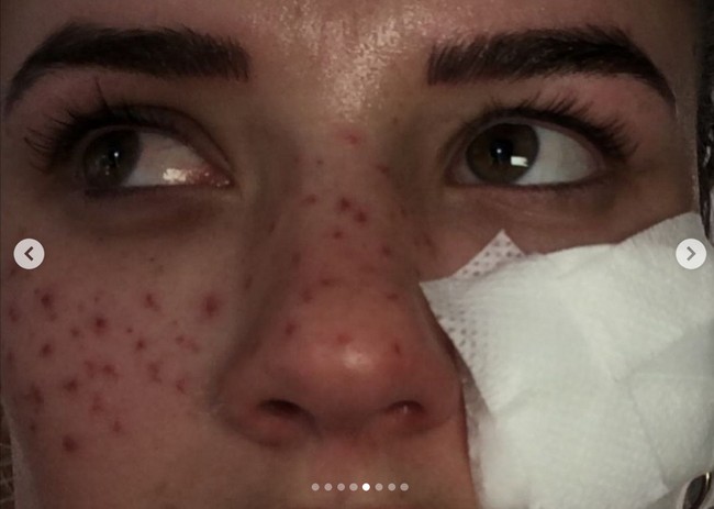 Hal buruk yang tak diduga Tilly kemudian terjadi. Wanita 21 tahun itu sempat mengalami kebutaan sementara di salah satu matanya dan dengan kemerahan parah di wajahnya.Foto: Instagram