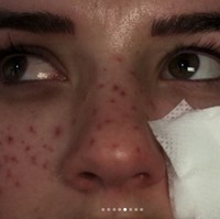 Hal buruk yang tak diduga Tilly kemudian terjadi. Wanita 21 tahun itu sempat mengalami kebutaan sementara di salah satu matanya dan dengan kemerahan parah di wajahnya.Foto: Instagram