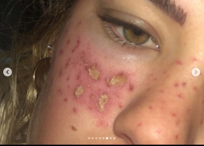 Tilly melakukan DIY kecantikan dari TikTok yakni melakukan akupuntur wajahnya sendiri.  Foto: Instagram