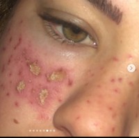 Tilly melakukan DIY kecantikan dari TikTok yakni melakukan akupuntur wajahnya sendiri.  Foto: Instagram